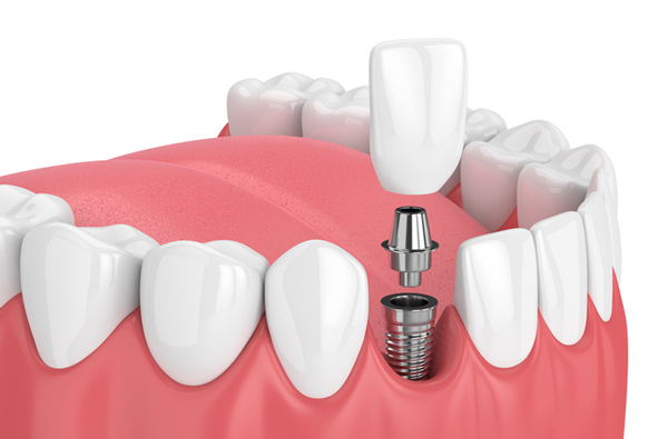 Rendering of jaw with dental implant at Cramer Dental in Blue Bell, PA