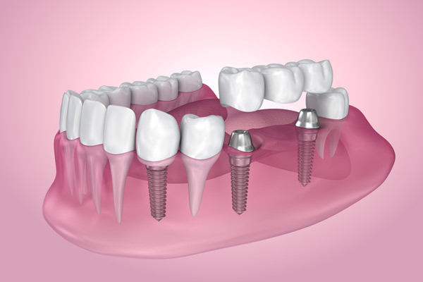 3D rendering of mouth with multiple dental implants at Cramer Dental in Blue Bell, PA