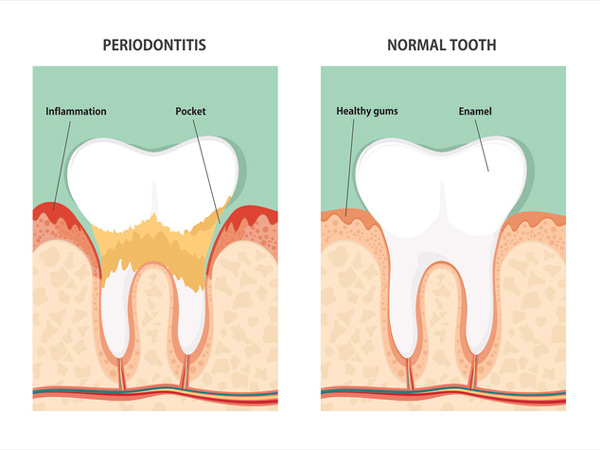 Diagram of a tooth with periodontitis and a healthly tooth from Cramer Dental in Blue Bell, PA