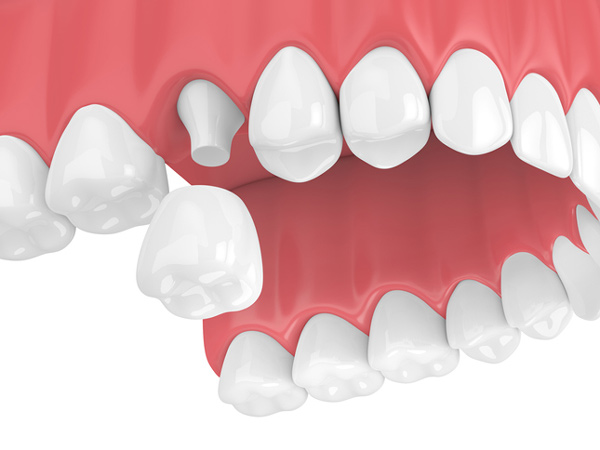 Rendering of jaw with dental crown from Cramer Dental in Blue Bell, PA