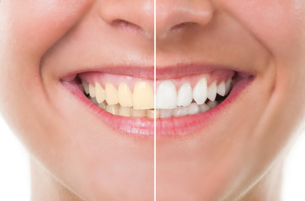 Before and after photo of teeth whitening treatment at Cramer Dental in Blue Bell, PA